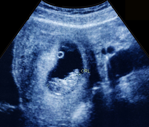 first trimester dating scan